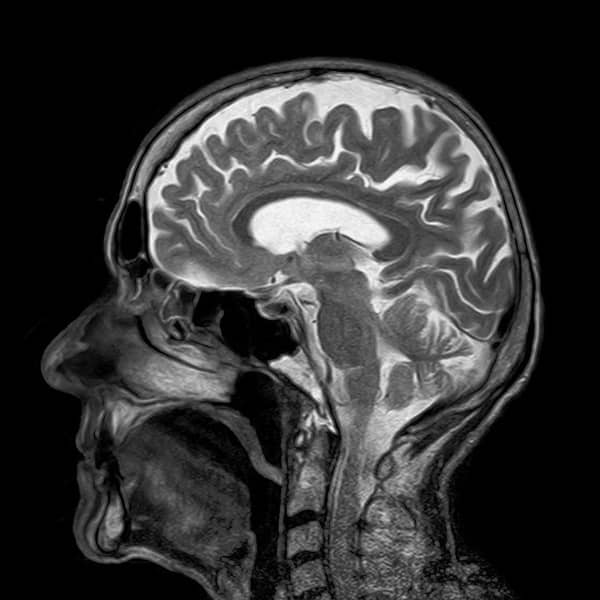 HSE betegség kimutatására készített Koponya MRI
